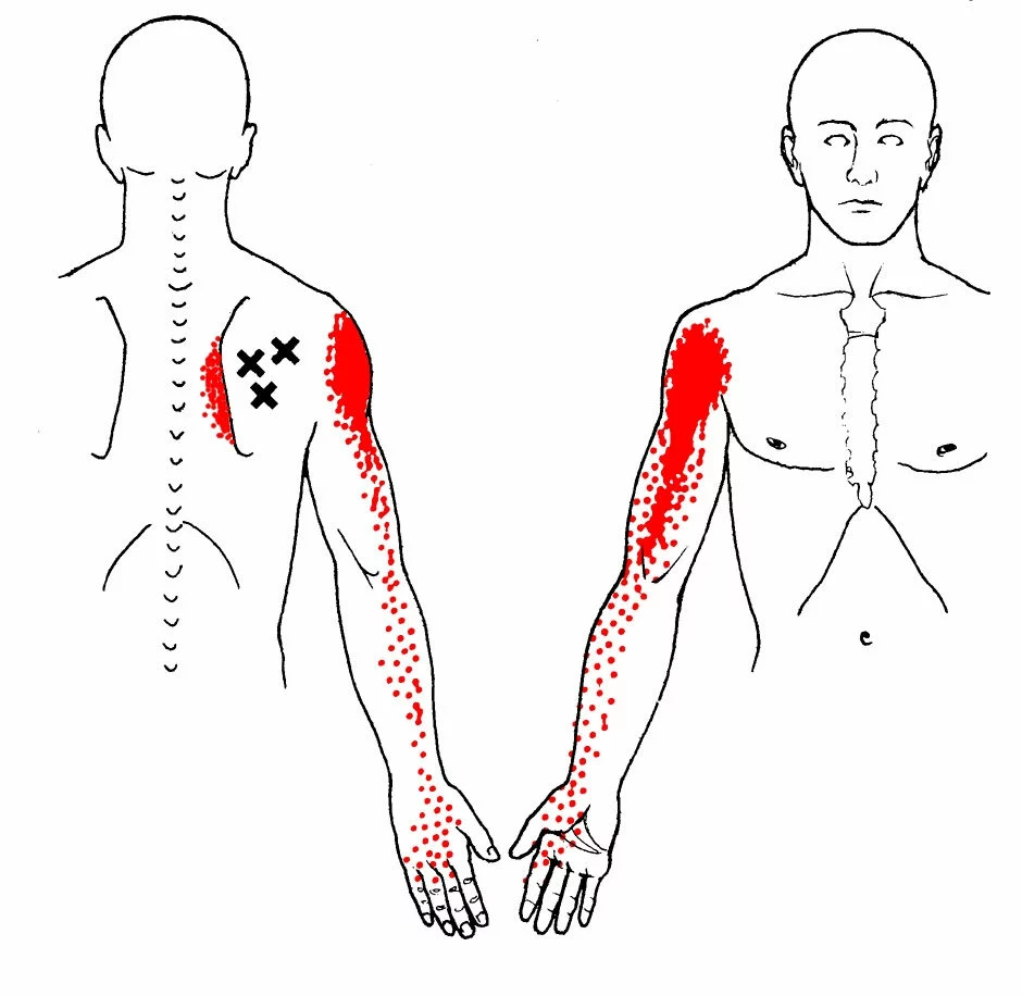 Nakkesmerter kan komme sammen med triggerpunkt i skuldermuskulaturen.
